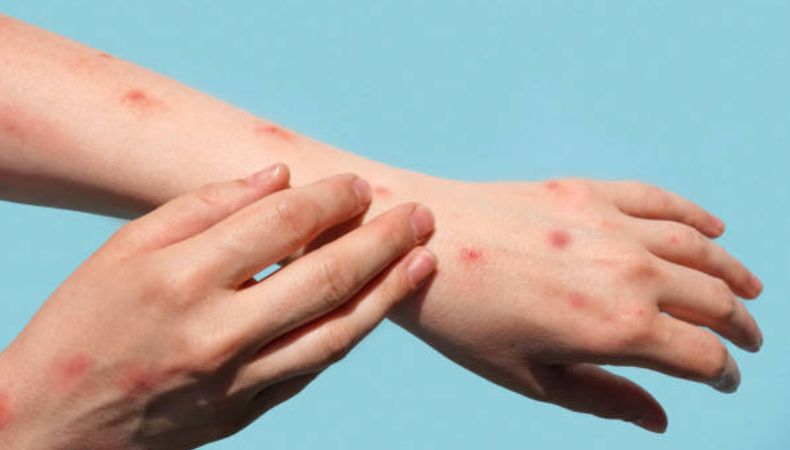 Mpox ya no es una emergencia sanitaria mundial: OMS