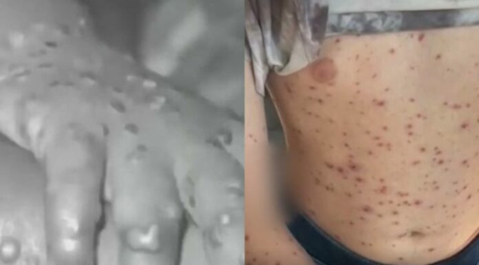 En México las autoridades de Salud reportan más de 50 casos de Mpox en los últimos días, pero advierten que son de la anterior variante.