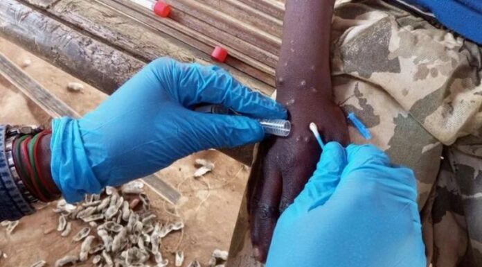 Un hombre de 66 años dio positivo a la nueva variante Mpox que tiene activa una emergencia internacional por el aumento de casos.