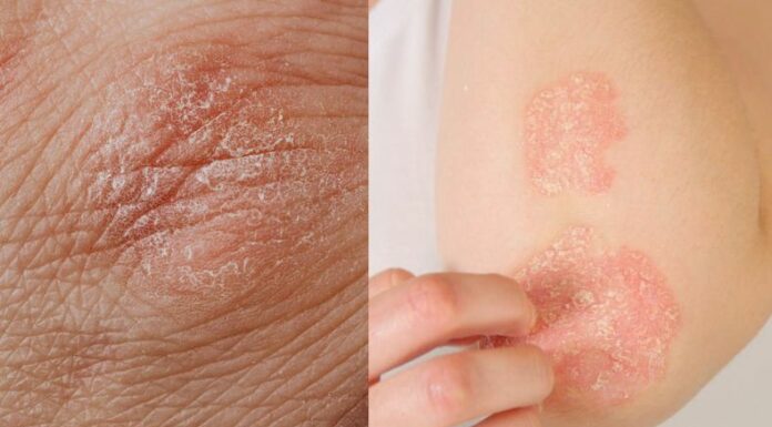 Cada 29 de octubre se concientiza sobre el Día Mundial de la Psoriasis. Una enfermedad inflamatoria que se manifiesta en la piel.