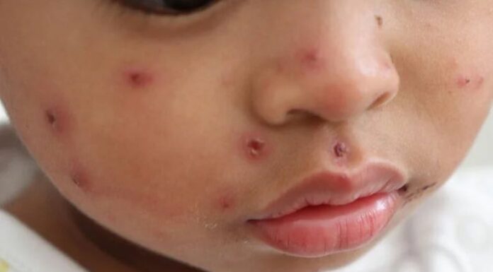 La Organización Panamericana de la Salud (OPS) emitió alerta epidemiológica por casos de sarampión en la región de las Américas.