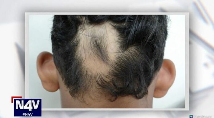 La alopecia, o pérdida de cabello, puede afectar solo al cuero cabelludo o extenderse a todo el cuerpo, siendo temporal o permanente.