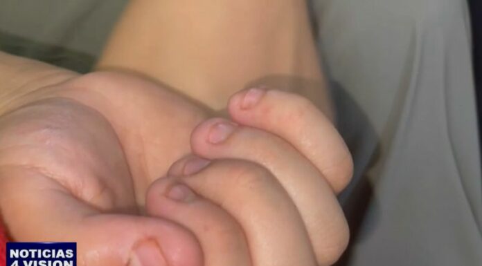 Morderse las uñas es un hábito común que afecta a millones de personas en todo el mundo, el cual puede tener efectos en la salud.