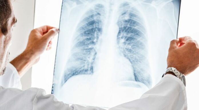 El cáncer de pulmón es la causa principal de muertes relacionadas con el cáncer en todo el mundo, según la OMS.