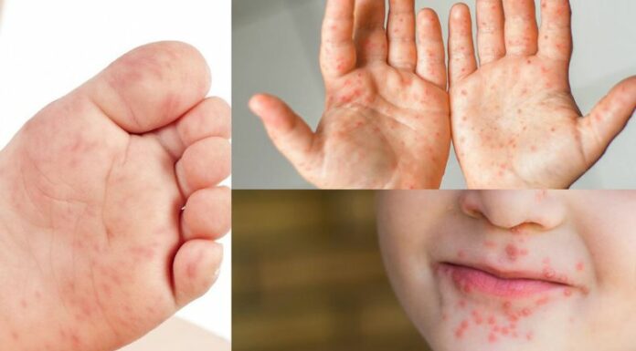 Médicos advierten que, actualmente, el país se enfrenta a un brote muy fuerte de casos del virus de mano, pie y boca.