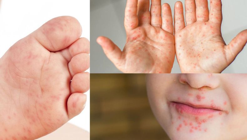 Médicos advierten que, actualmente, el país se enfrenta a un brote muy fuerte de casos del virus de mano, pie y boca.