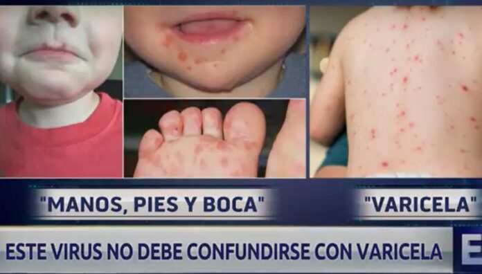 C mo Diferenciar Entre El Virus Manos Pies Y Boca Y La Varicela c-mo-diferenciar-entre-el-virus-manos-pies-y-boca-y-la-varicela