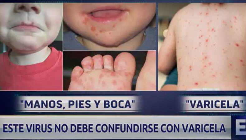 Cómo Diferenciar Entre El Virus Manos Pies Y Boca Y La Varicela