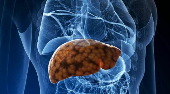 Según datos de la Biblioteca Nacional de Medicina de Estados Unidos, aproximadamente el 25% de la población mundial padece de hígado graso.