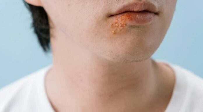 El herpes labial es una infección viral causada por el virus del herpes simple (VHS-1), que provoca ampollas o llagas en los labios y alrededor de la boca.