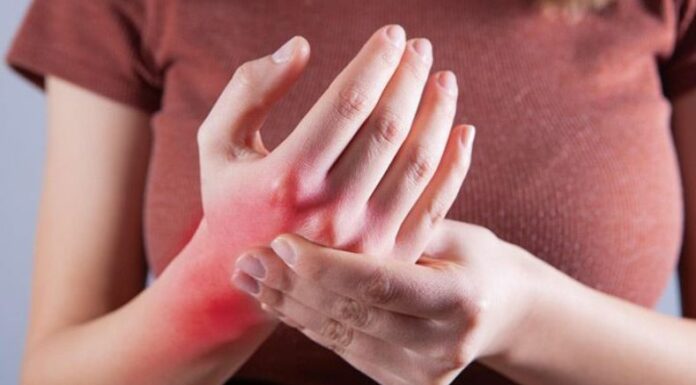 El lupus es una enfermedad crónica en la que el sistema inmunológico ataca por error los tejidos sanos del cuerpo, causando inflamación y daño en órganos como la piel, articulaciones, riñones y corazón.