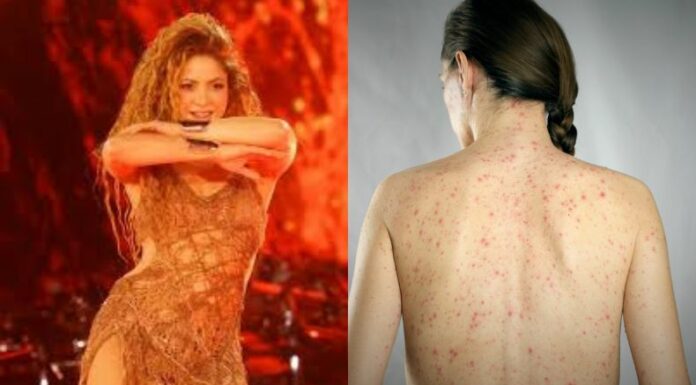 En las últimas horas Shakira, se ha convertido en foco de atención sanitaria, pues autoridades de salud investigan posible exposición masiva al sarampión.