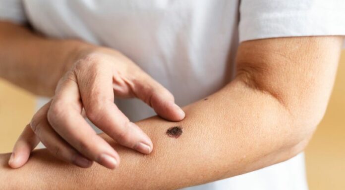 El Día Mundial del Melanoma, que se conmemora cada 23 de mayo, busca crear conciencia sobre los riesgos y cuidados frente a esta enfermedad.