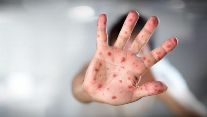 Casos de sarampión aumentan en la región