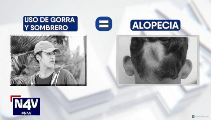 Mito o realidad ¿El uso de gorras o sombreros provoca pérdida de cabello ¿Alguna vez ha escuchado que usar gorras o sombreros provoca alopecia o pérdida de cabello? ¿Qué dicen los expertos al respecto?