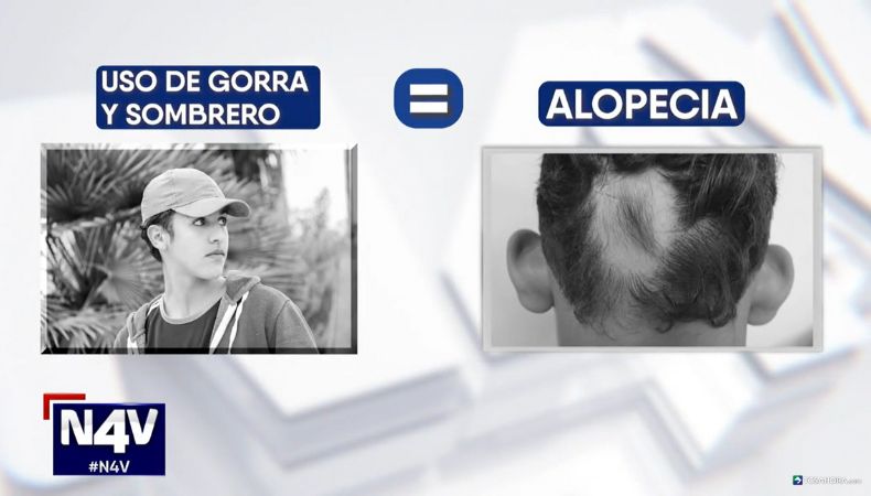 ¿Alguna vez ha escuchado que usar gorras o sombreros provoca alopecia o pérdida de cabello? ¿Qué dicen los expertos al respecto?