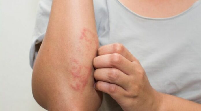 El estrés diario, ya sea por trabajo u otras responsabilidades, puede manifestarse en la piel a través de dermatitis nerviosa y brotes cutáneos.