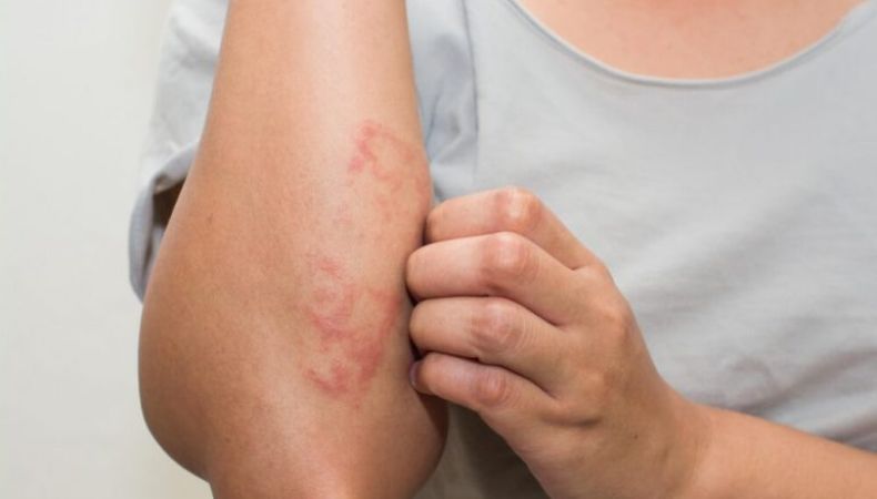 El estrés diario, ya sea por trabajo u otras responsabilidades, puede manifestarse en la piel a través de dermatitis nerviosa y brotes cutáneos.