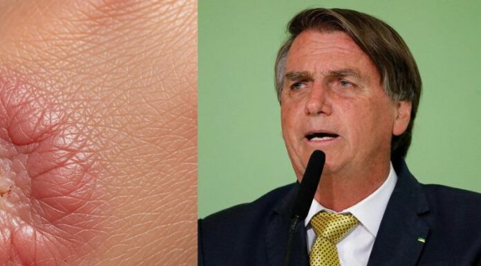 El expresidente de Brasil, Jair Bolsonaro, condenado la semana pasada por intento de golpe de Estado, fue diagnosticado de cáncer de piel en etapa temprana.