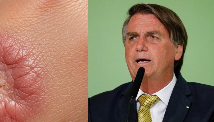 Jair Bolsonaro es diagnosticado con cáncer de piel en etapa temprana El expresidente de Brasil, Jair Bolsonaro, condenado la semana pasada por intento de golpe de Estado, fue diagnosticado de cáncer de piel en etapa temprana.