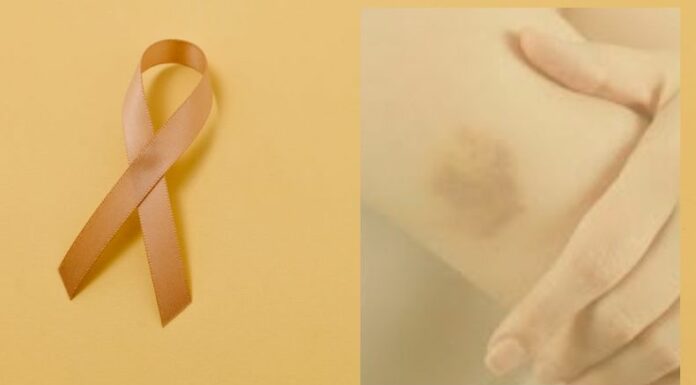 La leucemia crónica es un tipo de cáncer de la sangre y la médula ósea que se desarrolla de manera lenta y progresiva. Aunque no tiene cura definitiva, existen tratamientos que permiten controlarla.