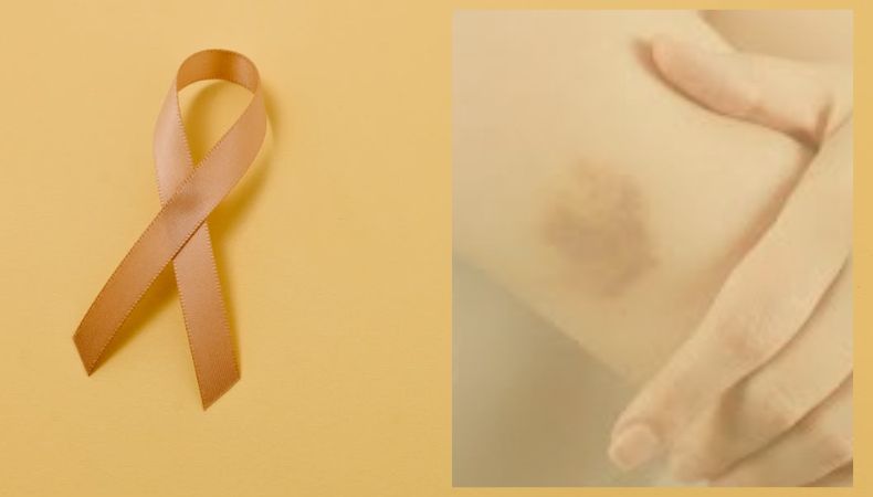 La leucemia crónica es un tipo de cáncer de la sangre y la médula ósea que se desarrolla de manera lenta y progresiva. Aunque no tiene cura definitiva, existen tratamientos que permiten controlarla.