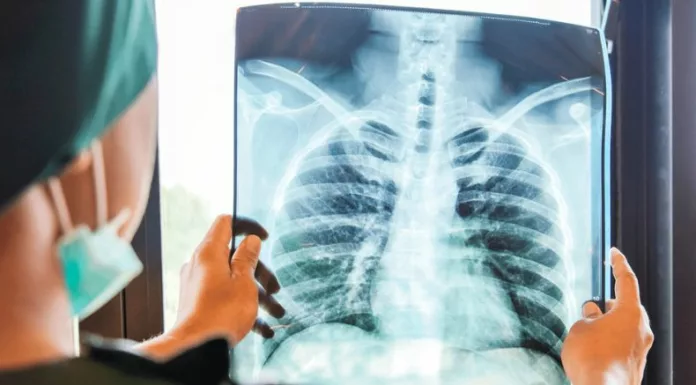 Según el Centro Internacional de Investigaciones sobre el Cáncer, el cáncer de pulmón provocó 1.8 millones de muertes en el mundo hasta 2020.