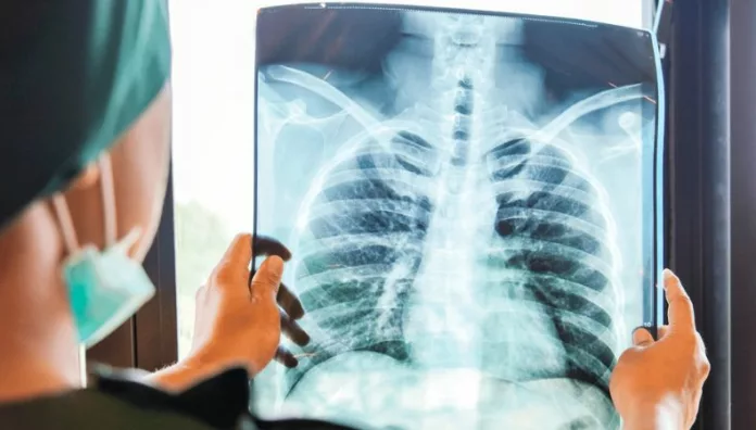 Día Mundial del Cáncer de Pulmón la detección temprana marca la diferencia Según el Centro Internacional de Investigaciones sobre el Cáncer, el cáncer de pulmón provocó 1.8 millones de muertes en el mundo hasta 2020.