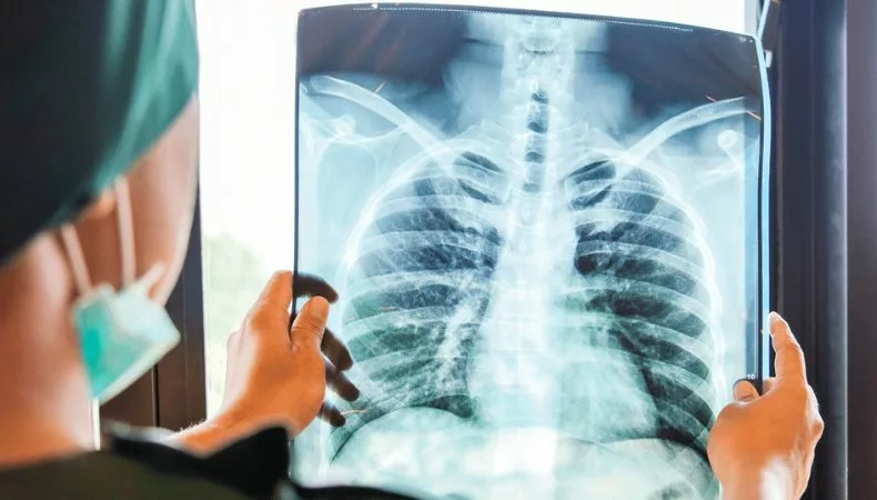 Según el Centro Internacional de Investigaciones sobre el Cáncer, el cáncer de pulmón provocó 1.8 millones de muertes en el mundo hasta 2020.