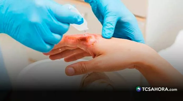 Las quemaduras no solo requieren atención inmediata, también un cuidado médico constante para una recuperación adecuada.