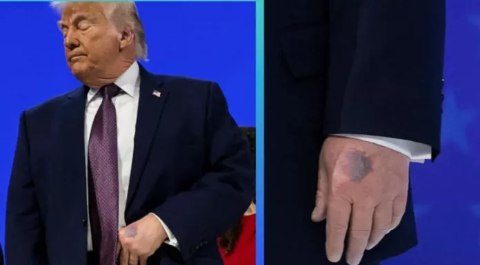 La salud de Donald Trump, de 79 años, de nuevo genera preguntas, sobre todo por los moretones que se vieron en su mano izquierda en Davos.