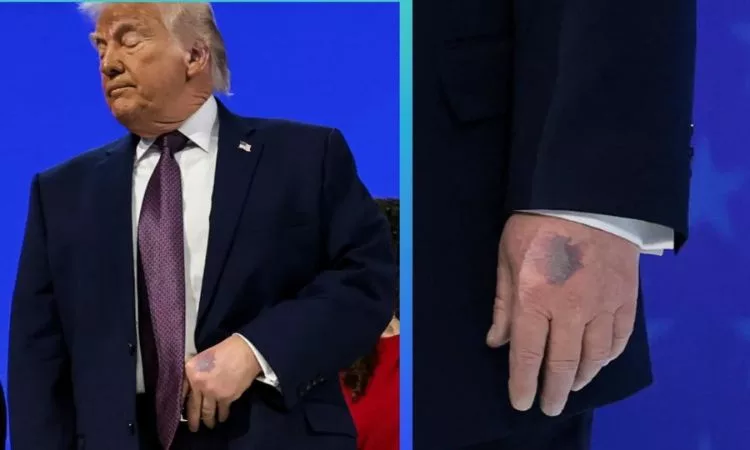 Trump con moretones en la mano, otra vez ¿Cómo está su salud?