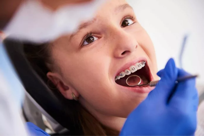 Los brackets ayudan a corregir la posición de los dientes y mejorar la sonrisa, pero muchas personas aún se preguntan cuál es la edad ideal para iniciar este tratamiento.