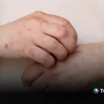 Colombia confirma cuatro casos importados de sarampión