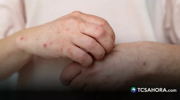 Las autoridades sanitarias colombianas confirmaron cuatro casos importados de sarampión asociados a viajes a México.