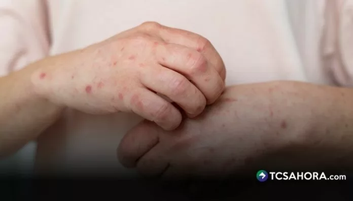 Las autoridades sanitarias colombianas confirmaron cuatro casos importados de sarampión asociados a viajes a México.