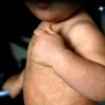 Ministerio de Salud confirma 11 casos de sarampión en El Salvador