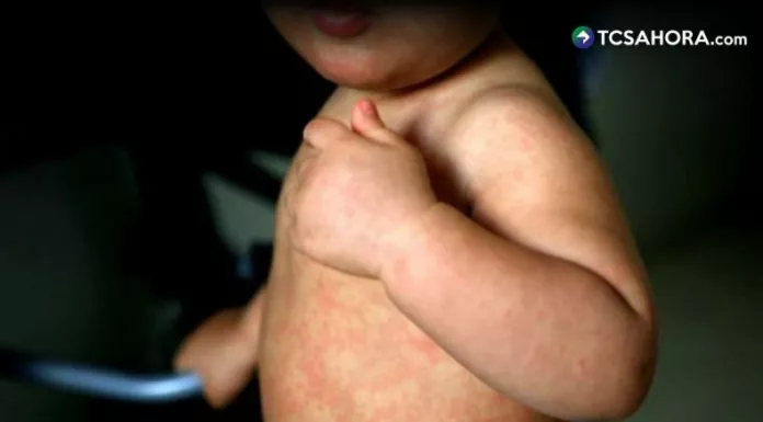 El ministro de Salud, Francisco Alabi informó que a partir de mañana iniciará una campaña de vacunación especial contra el sarampión.