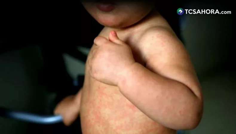 Cảnh báo dịch bệnh sởi tại El Salvador