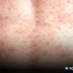 «Estamos ante un riesgo inminente»: presidente del Colegio Médico