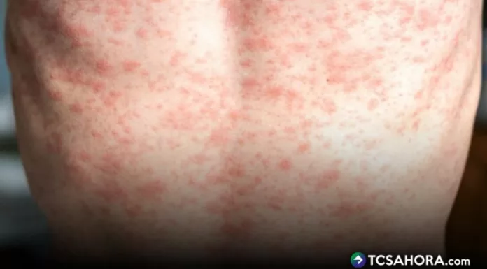 Presidente del COLMEDES, avaló varias acciones del MINSAL ante el sarampión, pero le exhortó a dar información más adecuada y precisa.