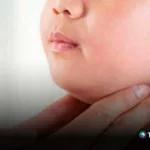 Ministerio de Salud reporta casos de paperas