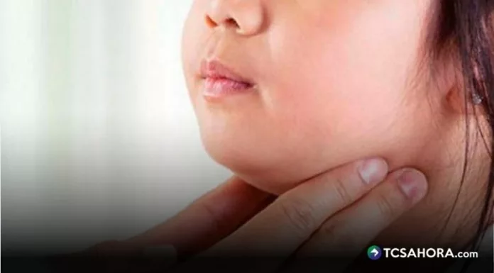 Las paperas son una enfermedad viral altamente contagiosa que inflama las glándulas salivales y provoca inflamación del rostro.