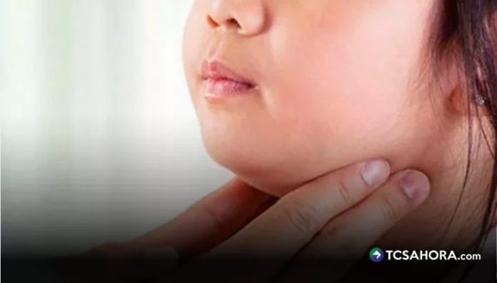 Las paperas son una enfermedad viral altamente contagiosa que inflama las glándulas salivales y provoca inflamación del rostro.