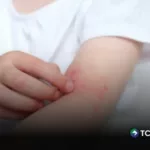 ¿Cómo prevenir el sarpullido en los niños durante la época de calor?