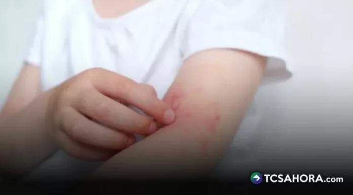 El sarpullido suele manifestarse en los niños durante los días de mucho calor y causa enrojecimiento y picazón en la piel.