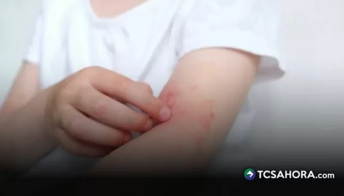 El sarpullido suele manifestarse en los niños durante los días de mucho calor y causa enrojecimiento y picazón en la piel.