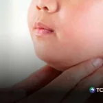 Incrementan contagios de paperas en niños y adolescentes