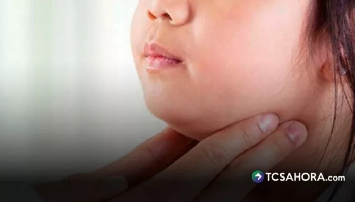 La parotiditis infecciosa, conocida popularmente como paperas, afecta principalmente a niños y adolescentes.