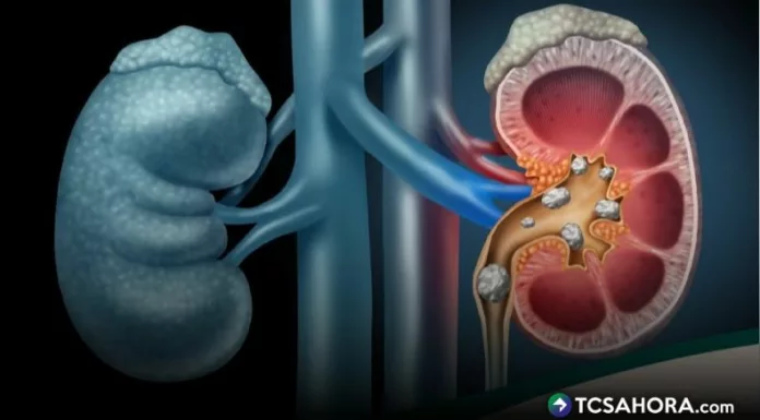 La alta frecuencia de cálculos en los riñones se da mucho más en temporada de calor: incrementa por la deshidratación del cuerpo.
